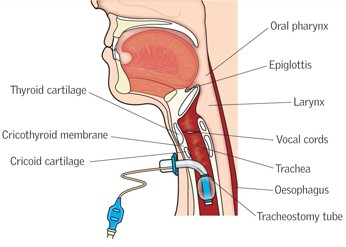 Tracheostomy tube cuff management22